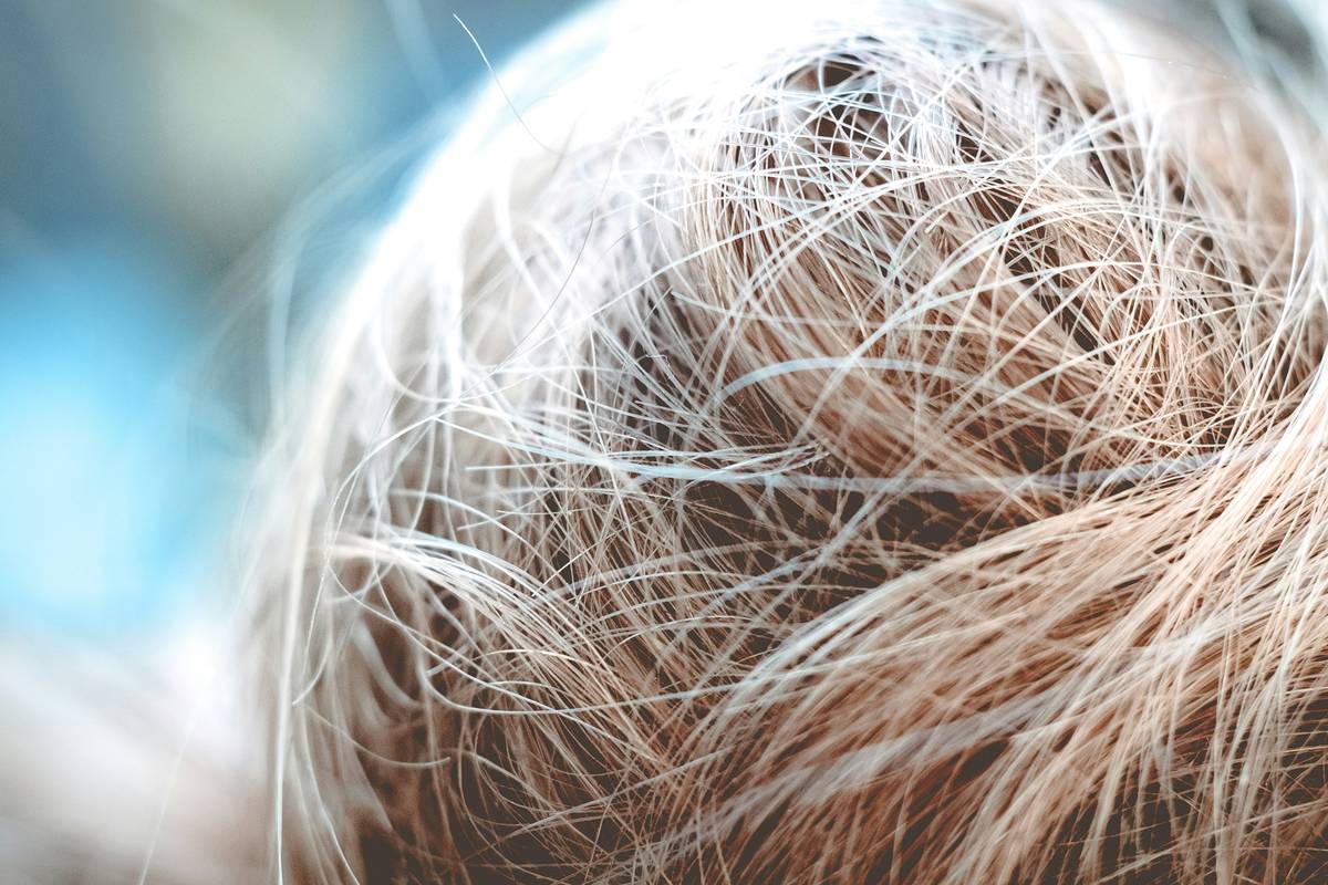 Before-and-after photos of bald scalp: Day 1 shows redness and flakes; Day 90 shows smooth, even-toned skin