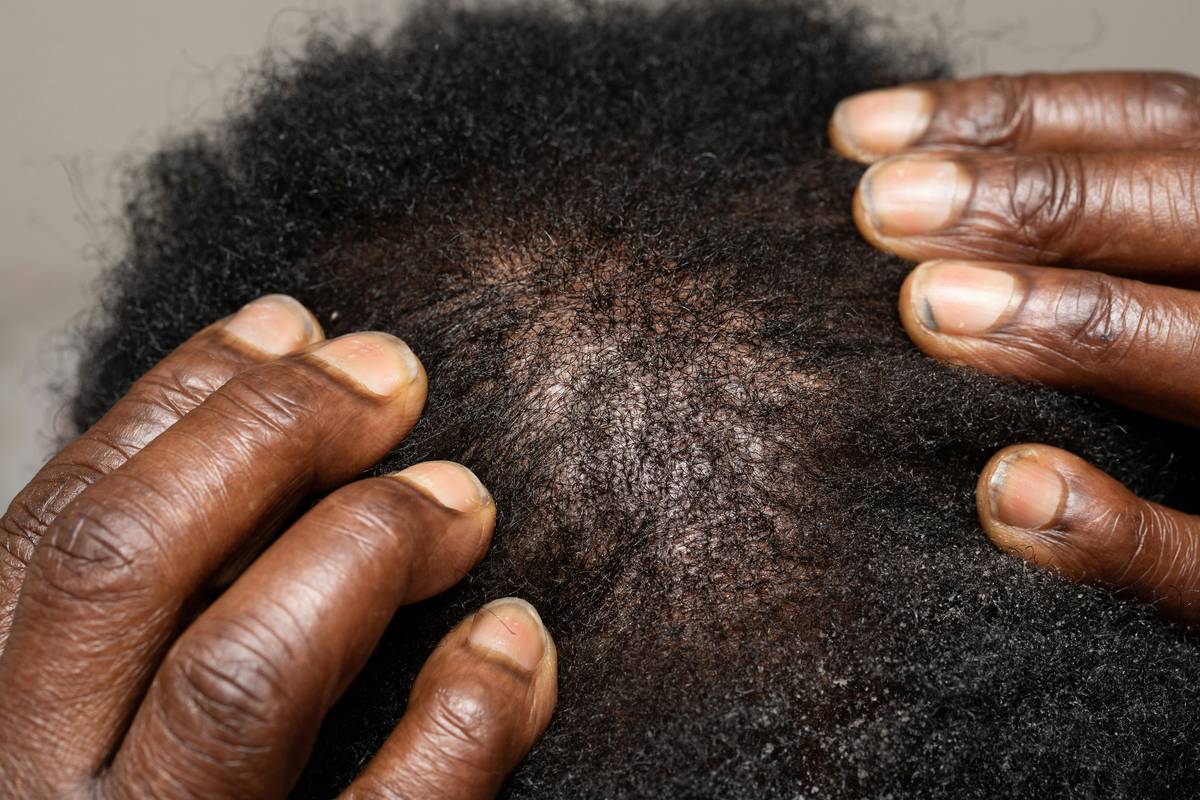 Skin Care for Bald Head: The Moisture & Protection Protocol Most Dermatologists Won’t Tell You